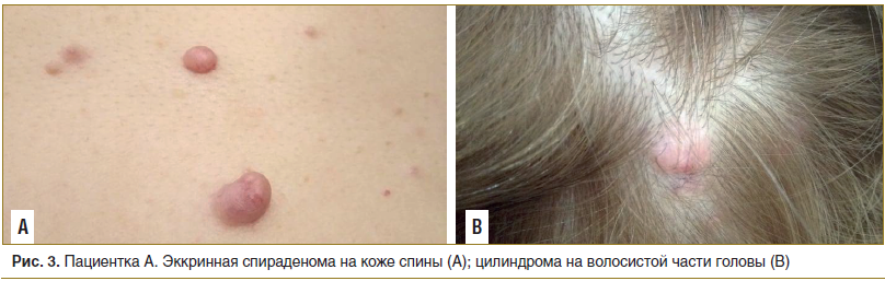Рис. 3. Пациентка А. Эккринная спираденома на коже спины (А); цилиндрома на волосистой части головы (В)
