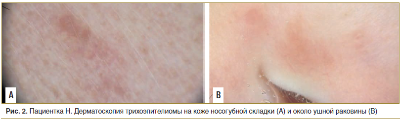 Рис. 2. Пациентка Н. Дерматоскопия трихоэпителиомы на коже носогубной складки (А) и около ушной раковины (В)