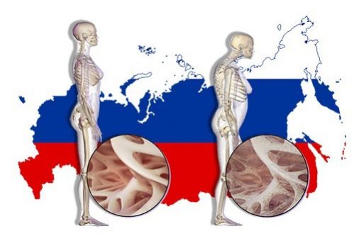 1 перелом в 3 минуты. Последствия остеопороза в России станут тяжелее, если не принять меры — МедНовости
