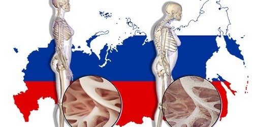 1 перелом в 3 минуты. Последствия остеопороза в России станут тяжелее, если не принять меры — МедНовости