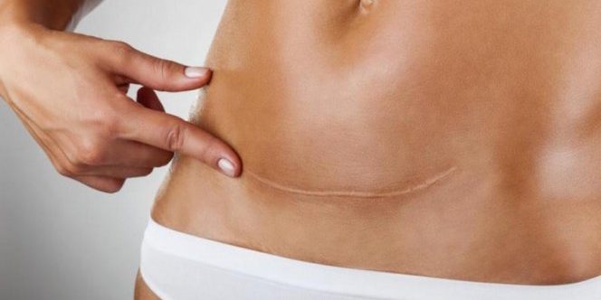 Кесарево сечение увеличивает риск ожирения у детей на 59%