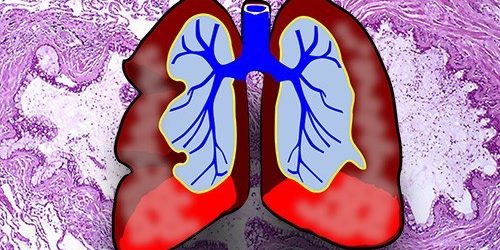 Обострение астмы связали с микробиомом дыхательных путей — МедНовости