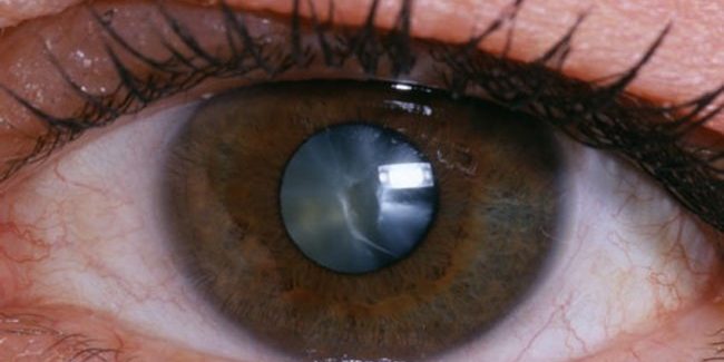 Пациенты с аллергией и астмой на 50% чаще сталкиваются с катарактами