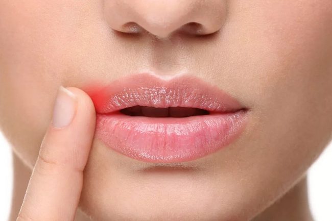 Врачи рассказали, почему трескаются губы и как этого избежать