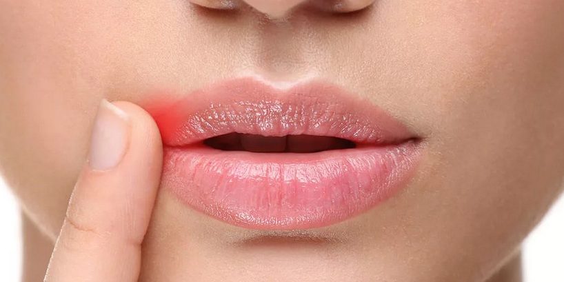 Врачи рассказали, почему трескаются губы и как этого избежать