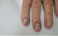 Рис. 4. Онихомикоз различной этиологии у одной больной: на одном пальце недерматомицетный (белая поверхностная форма), на другом — проксимальный кандидозный с паронихией