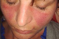 Ученые из Израиля и США разработали первое лекарство против волчанки