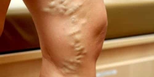 6 эффективных рецептов из меда и прополиса для защиты от варикоза