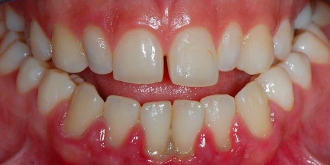 7 натуральных средств, для борьбы с воспалением десен