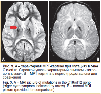 Рис. 3. А – характерная МРТ-картина при мутациях в гене C19orf12. Стрелкой указан характерный симптом «тигрового глаза». В – МРТ-картина в норме (представлена для сравнения) Fig. 3. A – MRI picture of mutations in the C19orf12 gene (