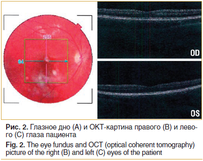 Рис. 2. Глазное дно (А) и ОКТ-картина правого (В) и левого (С) глаза пациента Fig. 2. The eye fundus and OCT (optical coherent tomography) picture of the right (B) and left (C) eyes of the patient