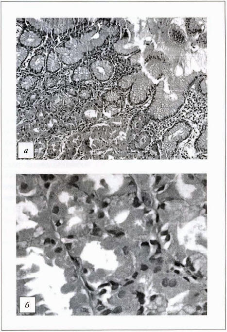 Рис. 2. Гистологическое исследование тела желудка (2013 г.): а - х100, окраска гематоксилином и эозином; б - х400, окраска гематоксилином и эозином
