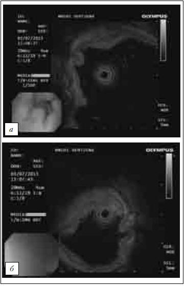 Рис. 3. Клиническое наблюдение № 1 Эндосонографическое исследование с частотой 20 МГц: а — опухоль исходит из слизистой оболочки желудка; б — инвазия опухоли практически на всю толщину подслизистого слоя (SM2–3) 