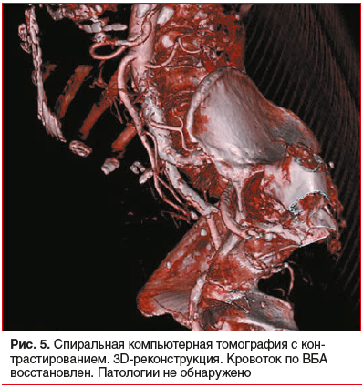 Рис. 5. Спиральная компьютерная томография с контрастированием. 3D-реконструкция. Кровоток по ВБА восстановлен. Патологии не обнаружено