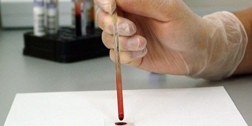 Анализ на антитела поможет понять реальные масштабы пандемии COVID-19 — МедНовости