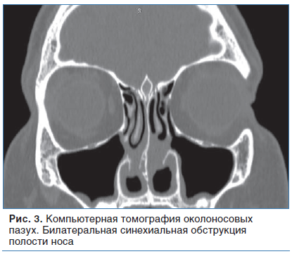 Рис. 3. Компьютерная томография околоносовых пазух. Билатеральная синехиальная обструкция полости носа