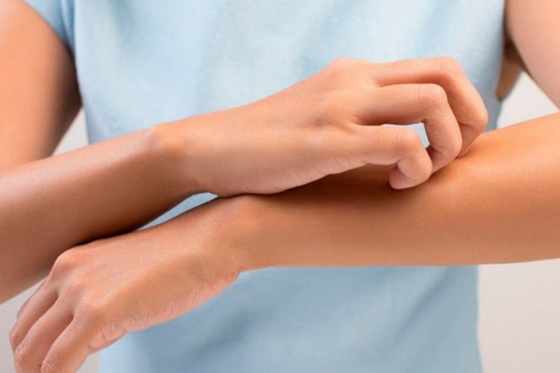 5 натуральных средств от кожной аллергии