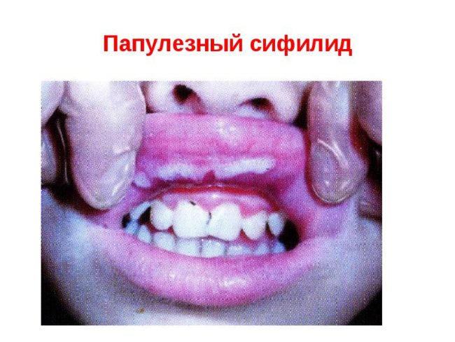 папулезный сифилид