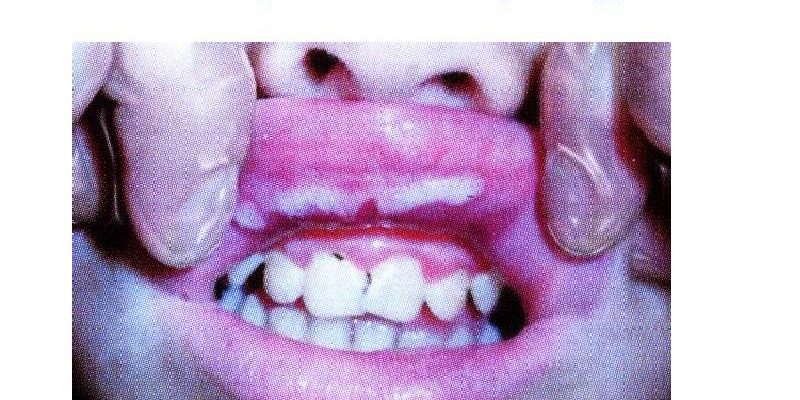 папулезный сифилид