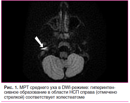 Рис. 1. МРТ среднего уха в DWI-режиме: гиперинтенсивное образование в области НСП справа (отмечено стрелкой) соответствует холестеатоме