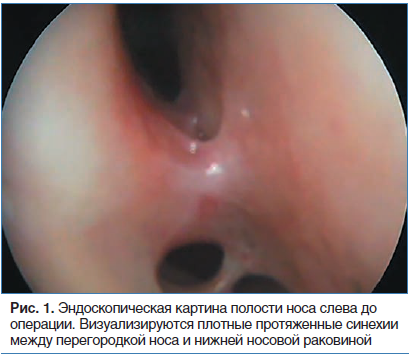 Рис. 1. Эндоскопическая картина полости носа слева до операции. Визуализируются плотные протяженные синехии между перегородкой носа и нижней носовой раковиной