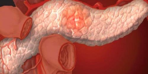 Панкреатит: 4 натуральных рецепта для улучшения состояния