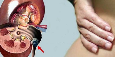 10 рецептов народной медицины в помощь при мочекаменной болезни