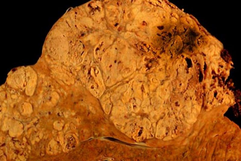 Новое лечение может спасти от распространенного рака печени