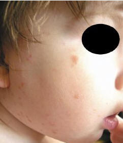 Рис. 4. Пигментная крапивница у того же ребенка (с мастоцитомами)