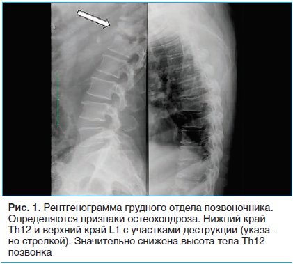 Рис. 1. Рентгенограмма грудного отдела позвоночника. Определяются признаки остеохондроза. Нижний край Th12 и верхний край L1 с участками деструкции (указано стрелкой). Значительно снижена высота тела Th12 позвонка