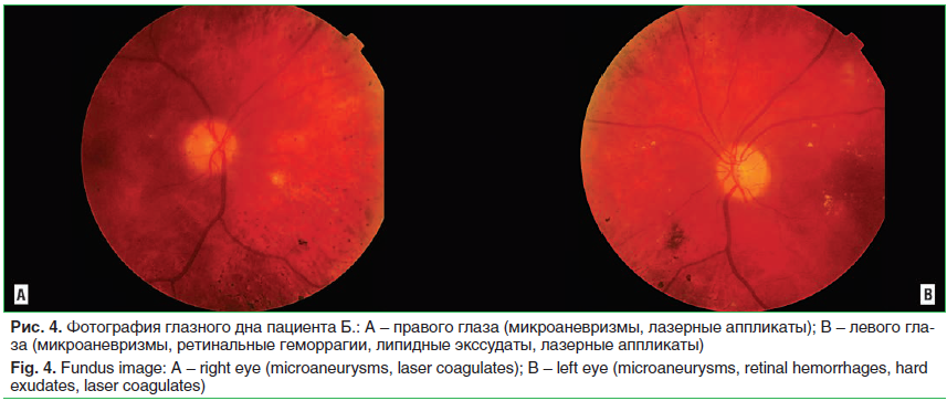 Рис. 4. Фотография глазного дна пациента Б.: A – правого глаза (микроаневризмы, лазерные аппликаты); B – левого гла- за (микроаневризмы, ретинальные геморрагии, липидные экссудаты, лазерные аппликаты) Fig. 4. Fundus image: A – right eye (microaneurysms, l