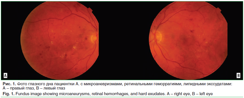 Рис. 1. Фото глазного дна пациентки А. с микроаневризмами, ретинальными геморрагиями, липидными экссудатами: A – правый глаз, B – левый глаз Fig. 1. Fundus image showing microaneurysms, retinal hemorrhages, and hard exudates. A – right eye, B – left eye