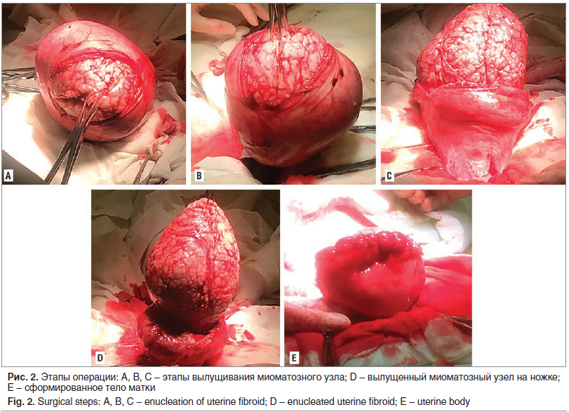 Рис. 2. Этапы операции: A, В, C – этапы вылущивания миоматозного узла; D – вылущенный миоматозный узел на ножке; E – сформированное тело матки Fig. 2. Surgical steps: A, B, C – enucleation of uterine fibroid; D – enucleated uterine fibroid; E – uterine bo