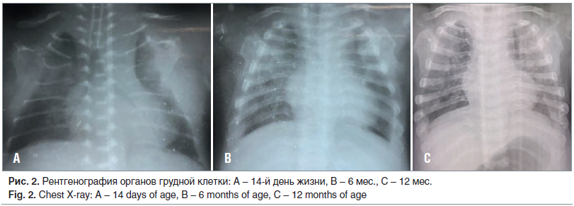 Рис. 2. Рентгенография органов грудной клетки: A – 14-й день жизни, B – 6 мес., C – 12 мес. Fig. 2. Chest X-ray: A – 14 days of age, B – 6 months of age, C – 12 months of age
