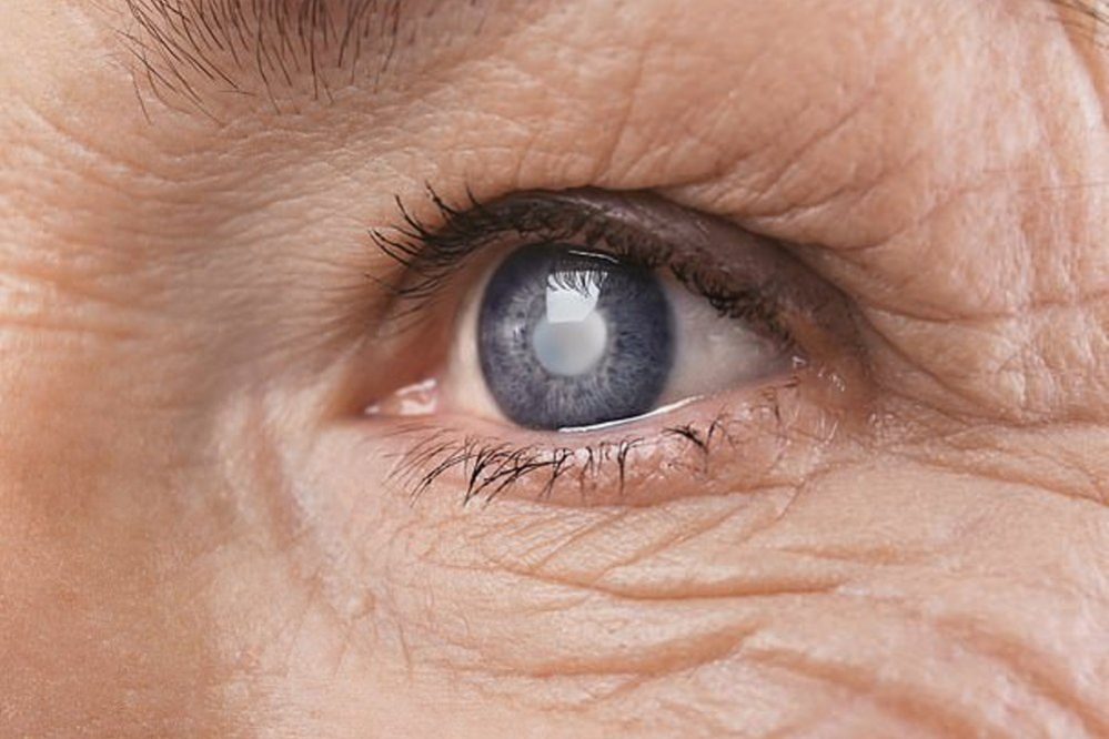 Растворимые глазные импланты помогут в лечении глаукомы