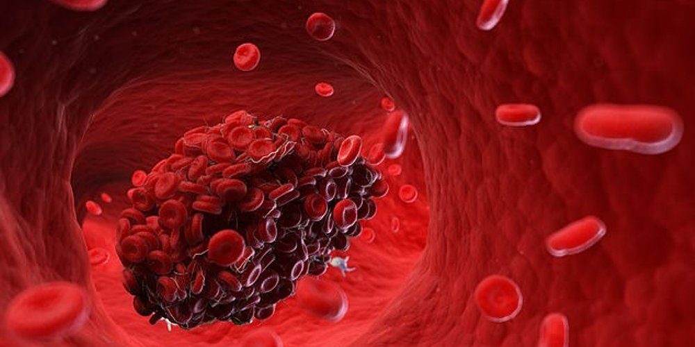 У всех умерших от коронавируса пациентов имелись тромбы