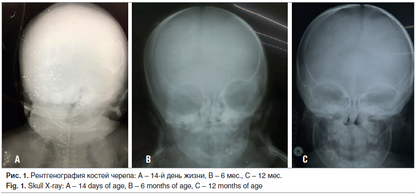 Рис. 1. Рентгенография костей черепа: A – 14-й день жизни, B – 6 мес., C – 12 мес. Fig. 1. Skull X-ray: A – 14 days of age, B – 6 months of age, C – 12 months of age