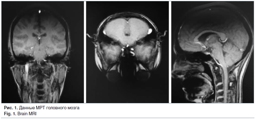 Рис. 1. Данные МРТ головного мозга Fig. 1. Brain MRI