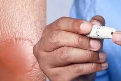 Симптомы диабета 2 типа: обращайте внимание на волдыри