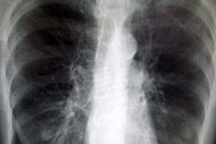 Университет Глазго нашел новый метод лечения астмы и ХОБЛа