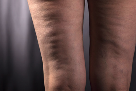 Врачи назвали эффективные способы избавления от целлюлита