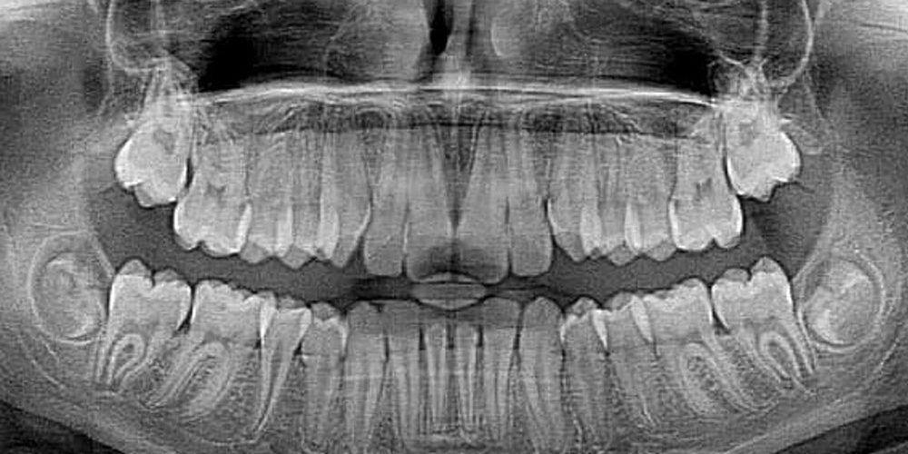 Рентгенография полости рта может выявить хроническое заболевание коронарной артерии
