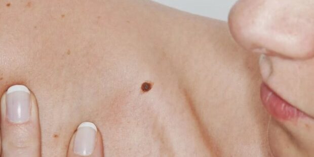 Как отличить меланому от обычной родинки — Медицина 2.0