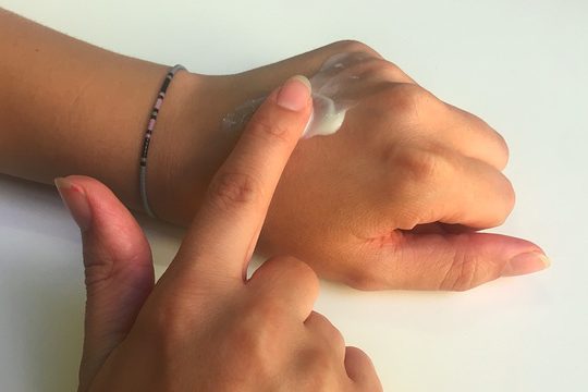 Зуд и красные пятна: как отличить крапивницу от псориаза?