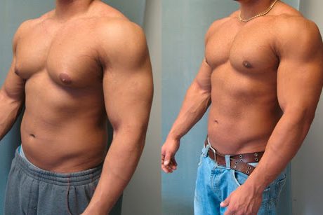 5 запретных продуктов при гинекомастии