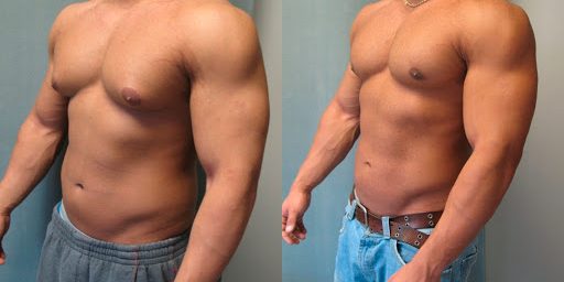 5 запретных продуктов при гинекомастии