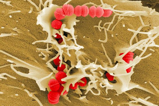 Ученые рассказали, почему скарлатина возвращается