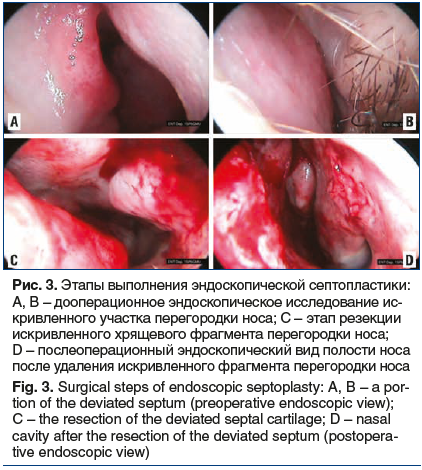 Рис. 3. Этапы выполнения эндоскопической септопластики: A, B – дооперационное эндоскопическое исследование ис- кривленного участка перегородки носа; C – этап резекции искривленного хрящевого фрагмента перегородки носа; D – послеоперационный эндоскопически