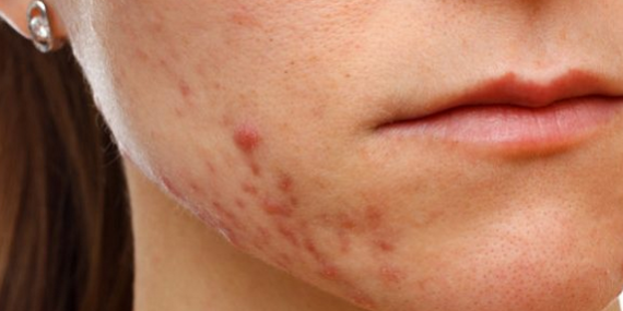 Исследование пролило свет на истинные причины появления акне