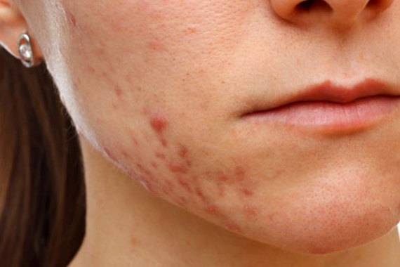 Исследование пролило свет на истинные причины появления акне